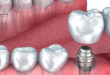 Преимущества услуг по протезированию зубов