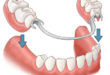 Преимущества и недостатки эффективного протезирования зубов